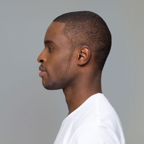 Otoplasty 05