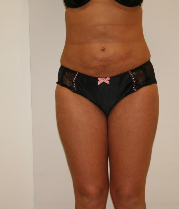 1 Liposuction After min v2