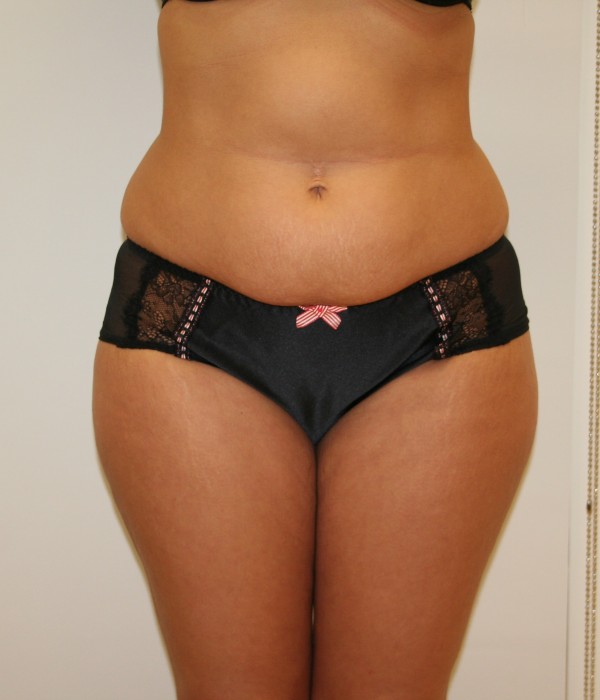 1 Liposuction Before min v2
