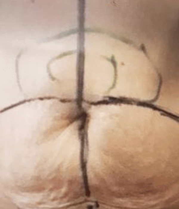 2 Liposuction Before v2