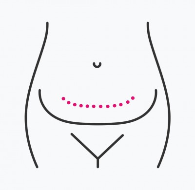Tummy Tuck v2